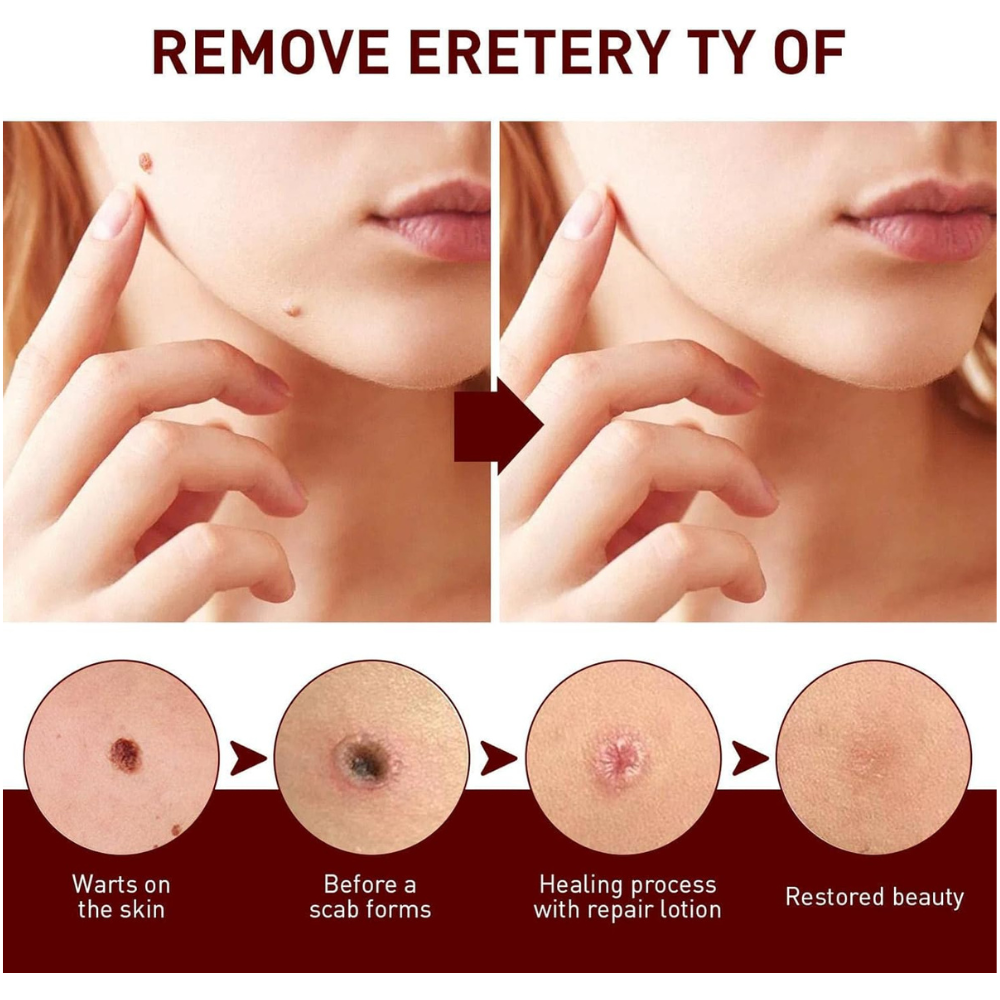 Last Day 50% OFF🔥Liquid Wart and Skin Tag Removal