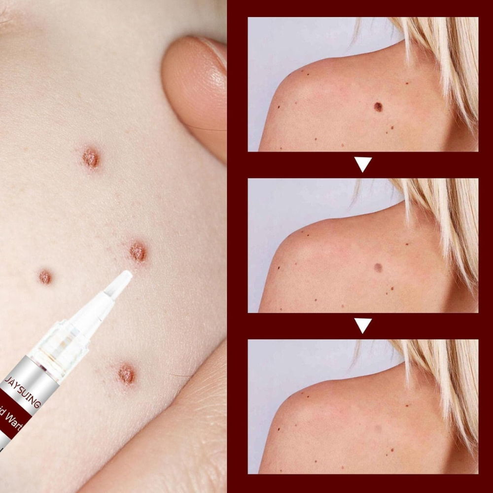 Last Day 50% OFF🔥Liquid Wart and Skin Tag Removal